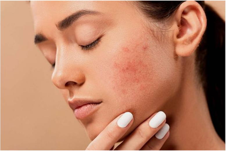 Da nhạy cảm là như thế nào, những người sở hữu da nhạy