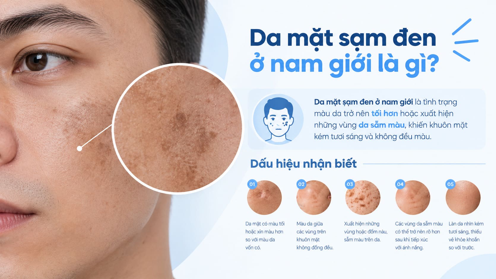 Các dấu hiệu thường gặp khi da mặt nam giới bị sạm, xỉn màu và tăng sắc tố