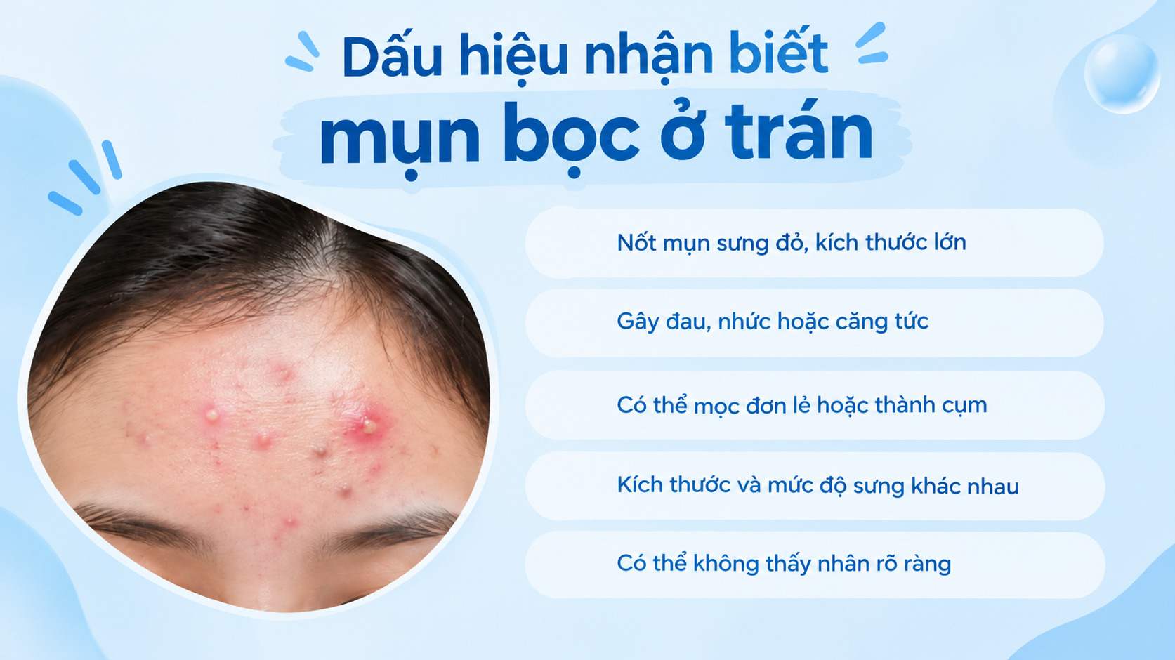 Mụn bọc ở trán thường biểu hiện bằng các nốt sưng đỏ, đau nhức và nằm sâu dưới da