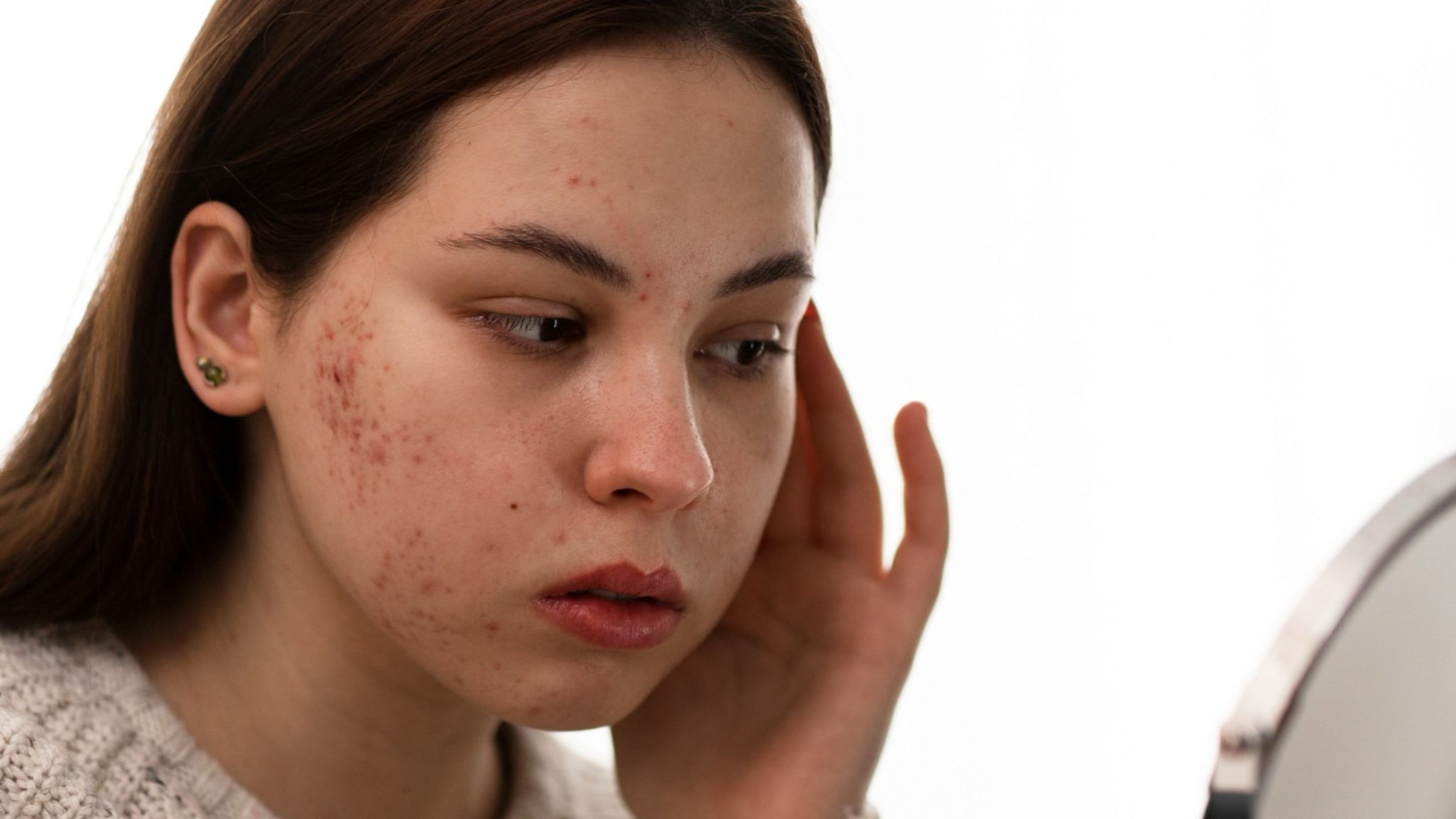 Hạn chế sờ hoặc nặn mụn để tránh kích ứng và kéo dài tình trạng viêm