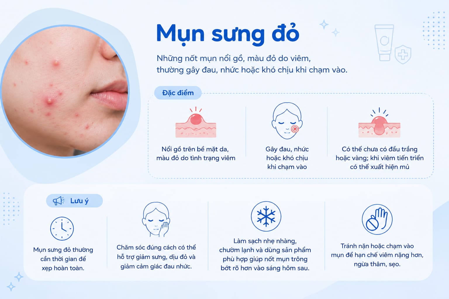 Mụn sưng đỏ là tình trạng mụn viêm thường gây đỏ, sưng và đau nhức trên da.