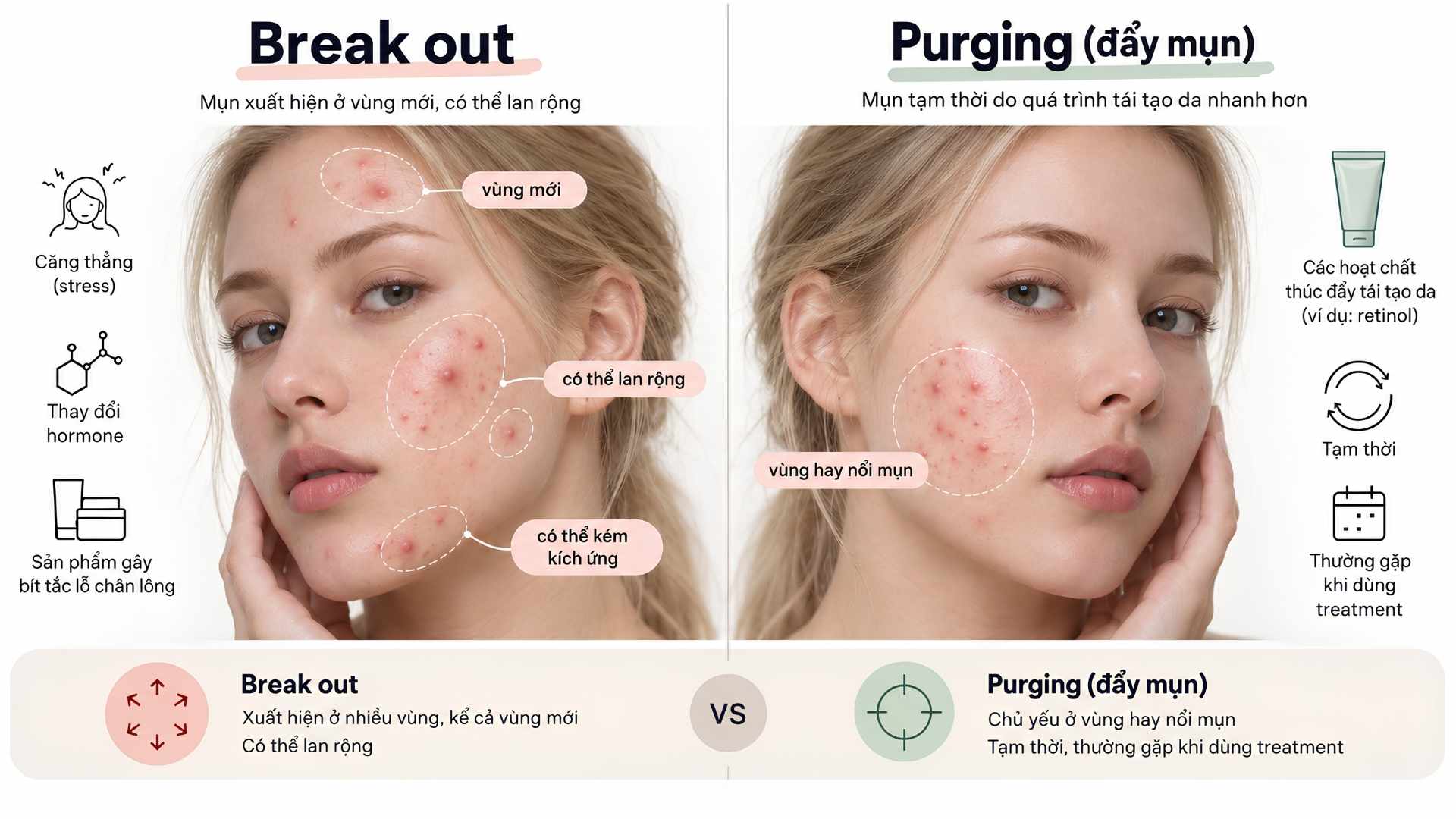 Break out và purging đều có thể khiến da nổi mụn nhiều hơn, nhưng khác nhau về nguyên nhân, vị trí xuất hiện và diễn biến theo thời gian