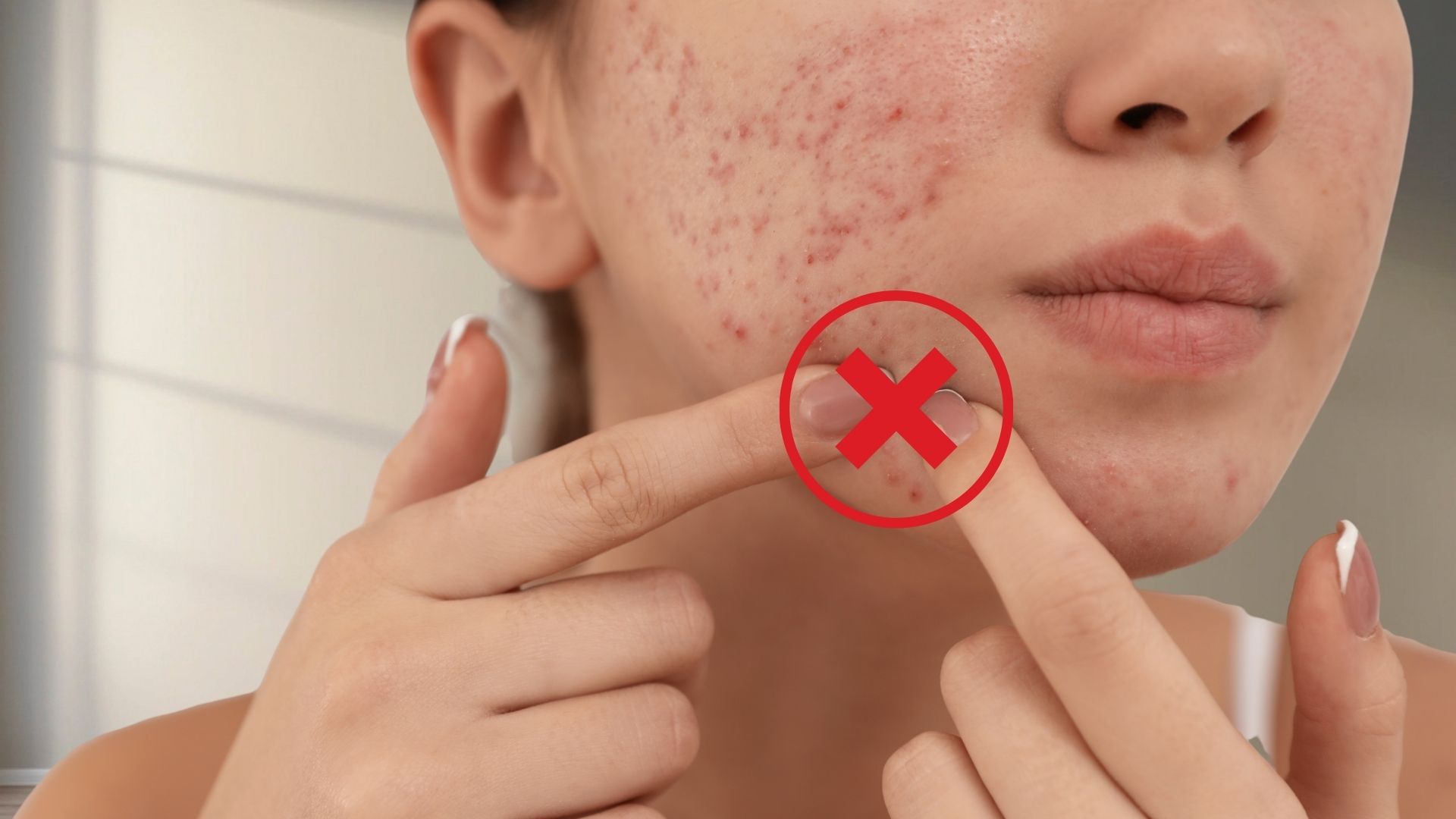 Hạn chế nặn hoặc cạy mụn giúp giảm tổn thương và nguy cơ để lại dấu sau mụn