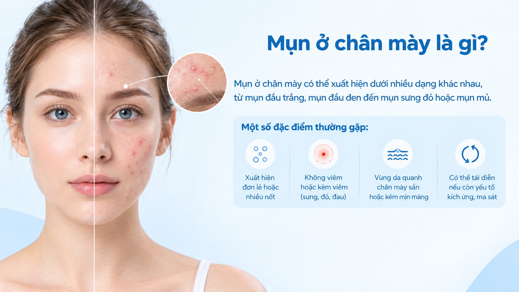 Mụn ở chân mày có thể xuất hiện dưới nhiều dạng, từ mụn đầu trắng, đầu đen đến mụn viêm
