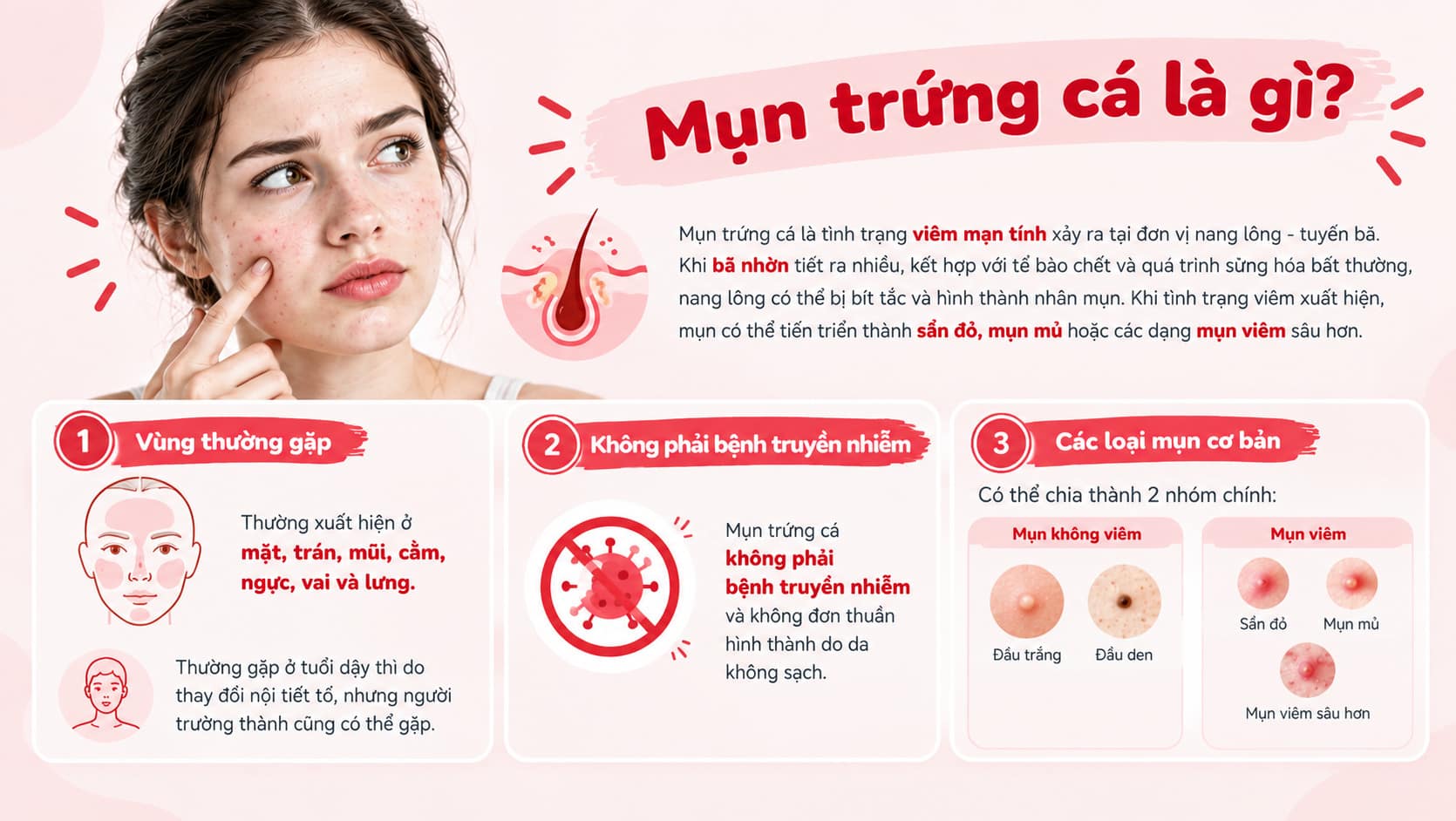 Mụn trứng cá là tình trạng viêm mạn tính xảy ra tại đơn vị nang lông - tuyến bã