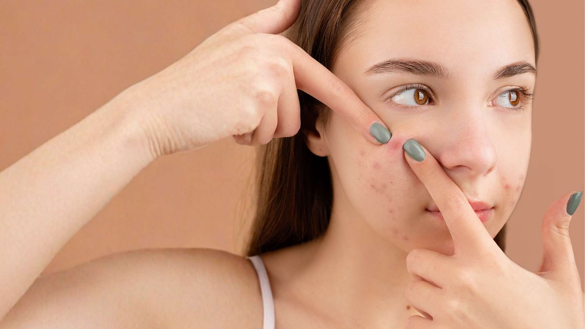 Hạn chế nặn, cạy hoặc chà xát giúp giảm tác động cơ học lên vùng da sau mụn
