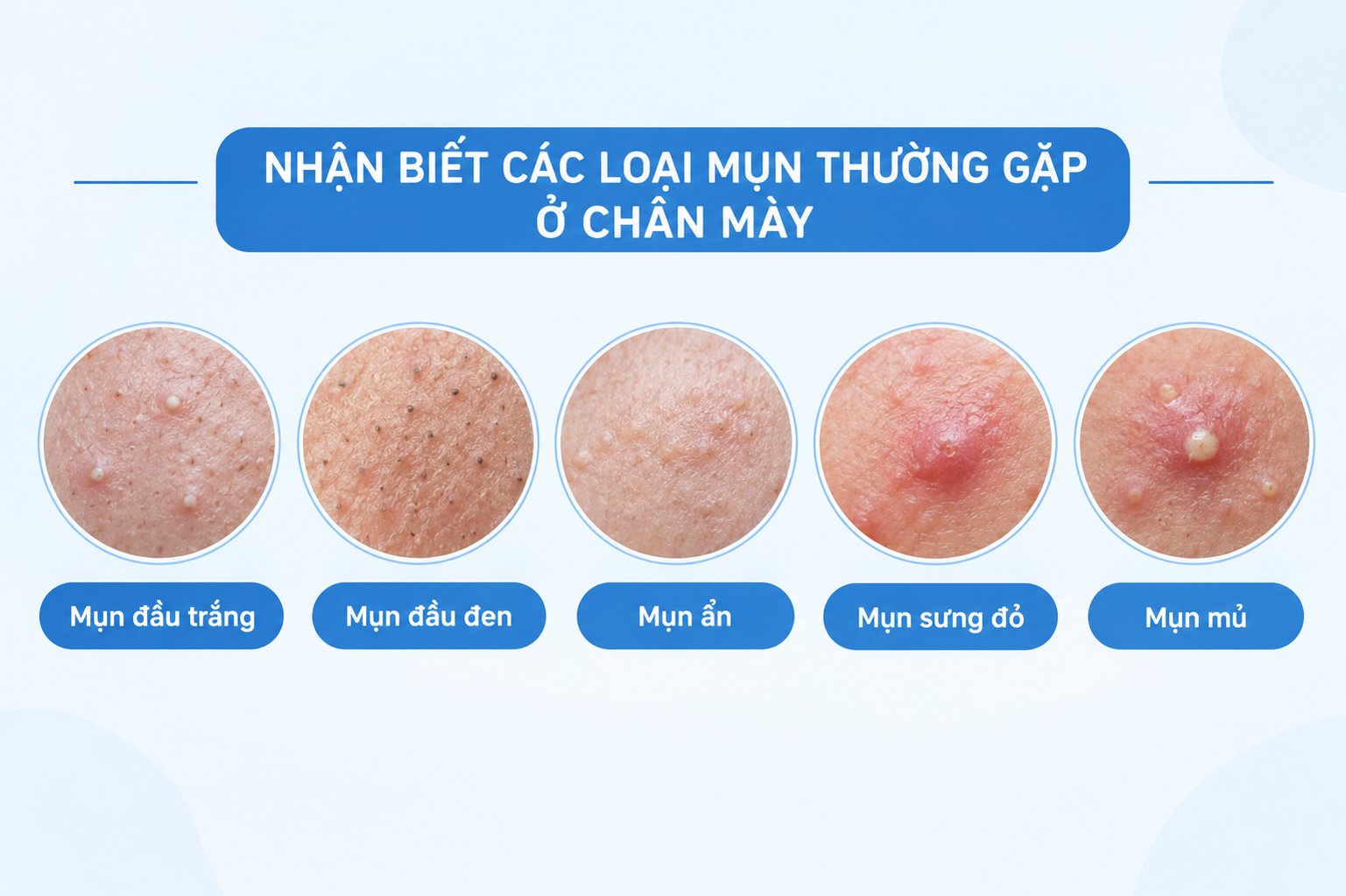 Phân biệt các dạng mụn phổ biến xuất hiện quanh vùng chân mày