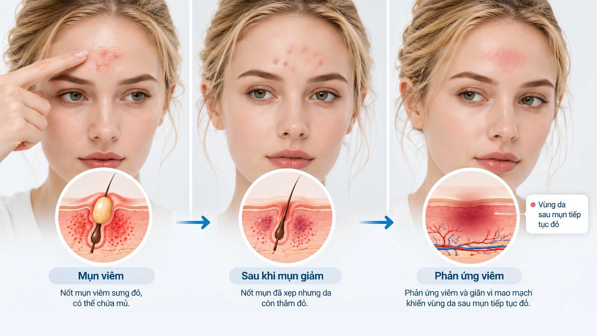 Phản ứng viêm sau mụn có thể khiến vùng da tiếp tục đỏ ngay cả khi tổn thương đã giảm