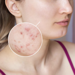 cách trị vết thâm mụn ở mặt 