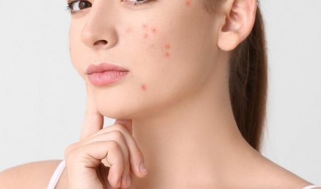 trị mụn tại nhà hiệu quả sau 1 đêm