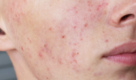 Vết thâm mụn có tự hết không