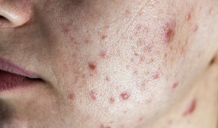 cách trị vết thâm mụn