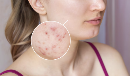 cách trị vết thâm mụn ở mặt 