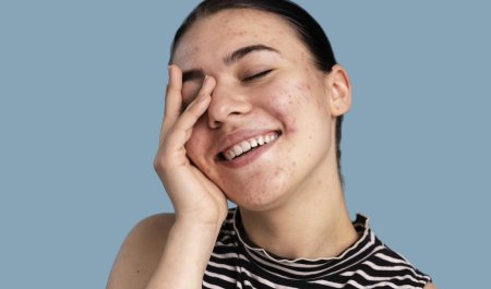 Top 10 serum dành cho da dầu mụn lỗ chân lông to 2026
