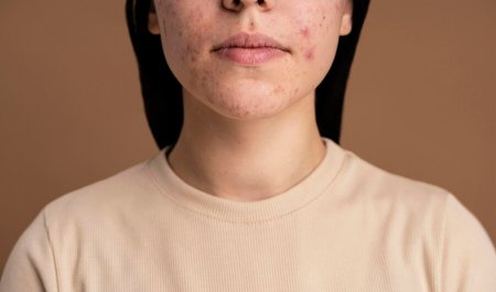 Mụn nội tiết là gì?