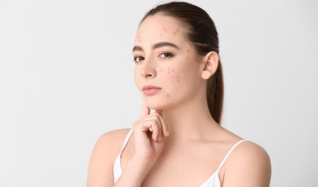 Mụn ẩn có tự hết không? Cùng Bioderma giải đáp