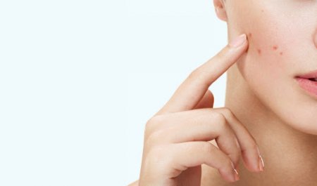 Ngăn ngừa và điều trị mụn trứng cá như thế nào?