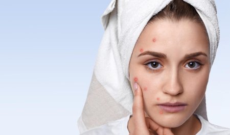 Mụn viêm có nên nặn không? Cách xử lý để hạn chế thâm sẹo