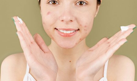 kem chống nắng cho da mụn