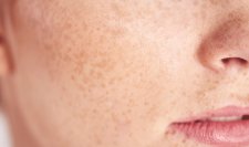 da nhạy cảm là gì da nhạy cảm là gì
