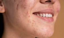 Thâm mụn là gì?