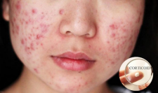 da nhiễm corticoid