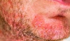 hình ảnh bị viêm da tiết bã nhờn