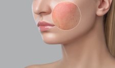 Cách xử lý khi bị dị ứng sữa rửa mặt một cách đơn giản.