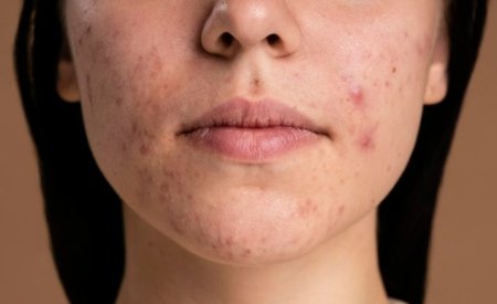 Cách làm xẹp mụn sưng đỏ sau 1 đêm an toàn, hiệu quả