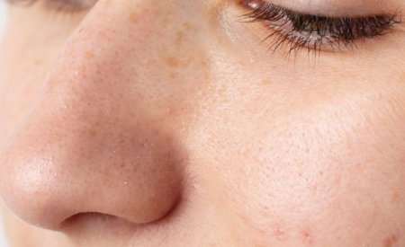 Da bị bít tắc lỗ chân lông: Nguyên nhân và cách khắc phục 