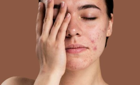 Da mặt đột nhiên nổi nhiều mụn: Cách xử lý hiệu quả