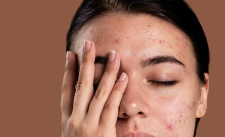 Mụn bọc ở trán: Nguyên nhân và cách cải thiện hiệu quả