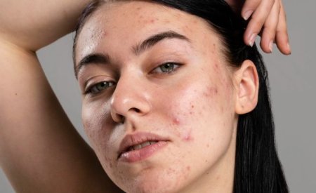 Mụn thái dương: Nguyên nhân và cách khắc phục hiệu quả