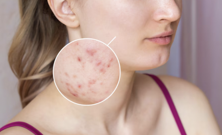 cách trị vết thâm mụn ở mặt 
