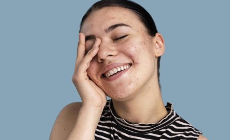 Top 10 serum dành cho da dầu mụn lỗ chân lông to 2026