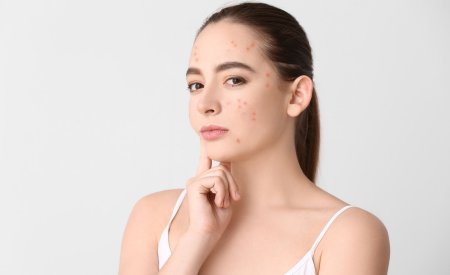 Mụn ẩn có tự hết không? Cùng Bioderma giải đáp