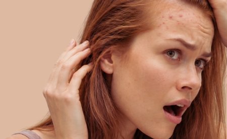 Mụn mọc ở trán gần chân tóc: Nguyên nhân và cách khắc phục
