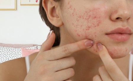 Mụn ở quai hàm: Dấu hiệu, Nguyên nhân và Cách trị hiệu quả