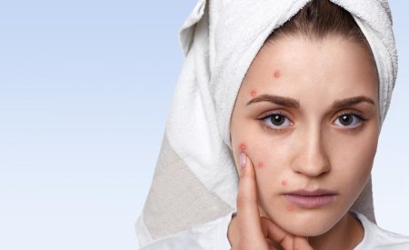 Mụn viêm có nên nặn không? Cách xử lý để hạn chế thâm sẹo