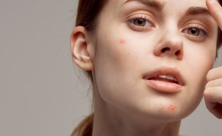 Giải đáp: Vị trí mụn trên mặt nói lên điều gì và cách xử lý 