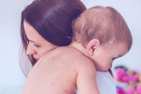 Baby with chicken pox needing a repairing care