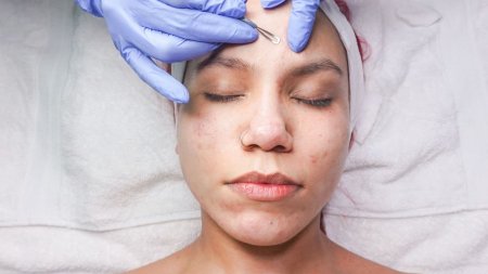 Lấy nhân mụn đúng kỹ thuật giúp loại bỏ nhân mụn và hạn chế nguy cơ viêm, thâm sau mụn