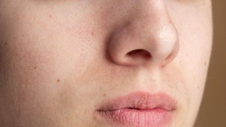Da bị bít tắc lỗ chân lông thường khiến bề mặt da sần sùi và xuất hiện mụn đầu đen