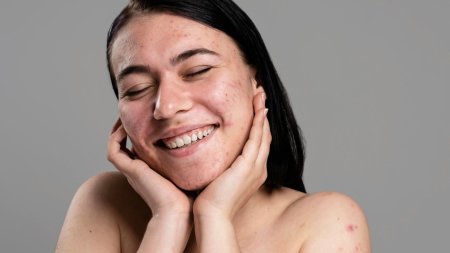 Thói quen chạm tay lên mặt có thể làm tăng nguy cơ nổi mụn