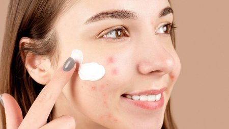Sử dụng kem chống nắng hằng ngày giúp bảo vệ da trước tia UV và hỗ trợ giảm nguy cơ hình thành vết thâm sau mụn