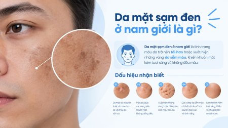 Các dấu hiệu thường gặp khi da mặt nam giới bị sạm, xỉn màu và tăng sắc tố