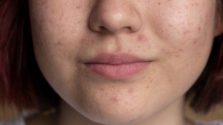 Mụn ở mũi là các nốt mụn  xuất hiện quanh vùng mũi vì đây là khu vực dễ tiết dầu, bụi bẩn, tế bào chết