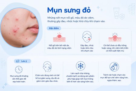 Mụn sưng đỏ là tình trạng mụn viêm thường gây đỏ, sưng và đau nhức trên da.