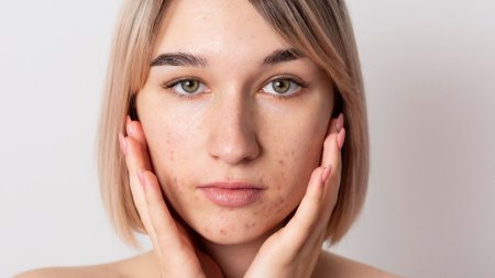 Thâm sau mụn có thể khiến một số vùng da sẫm màu hơn và làm da trông không đều màu. 