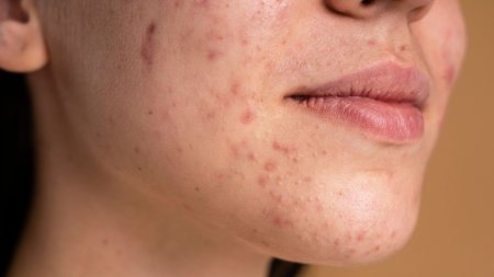 Sự thay đổi nội tiết tố có thể khiến mụn xuất hiện nhiều ở vùng cằm, quai hàm và quanh miệng